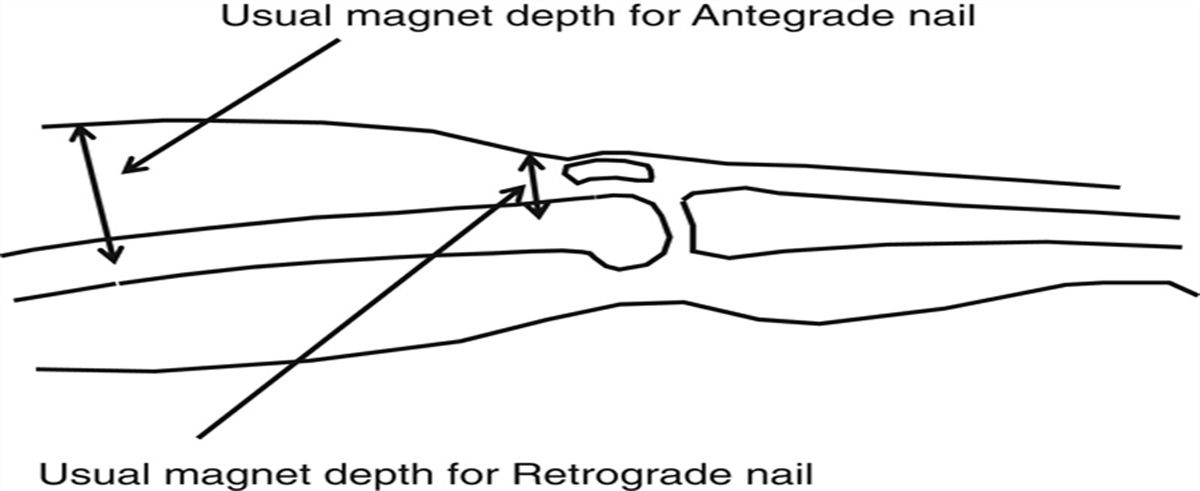 The Antegrade Femur Technique