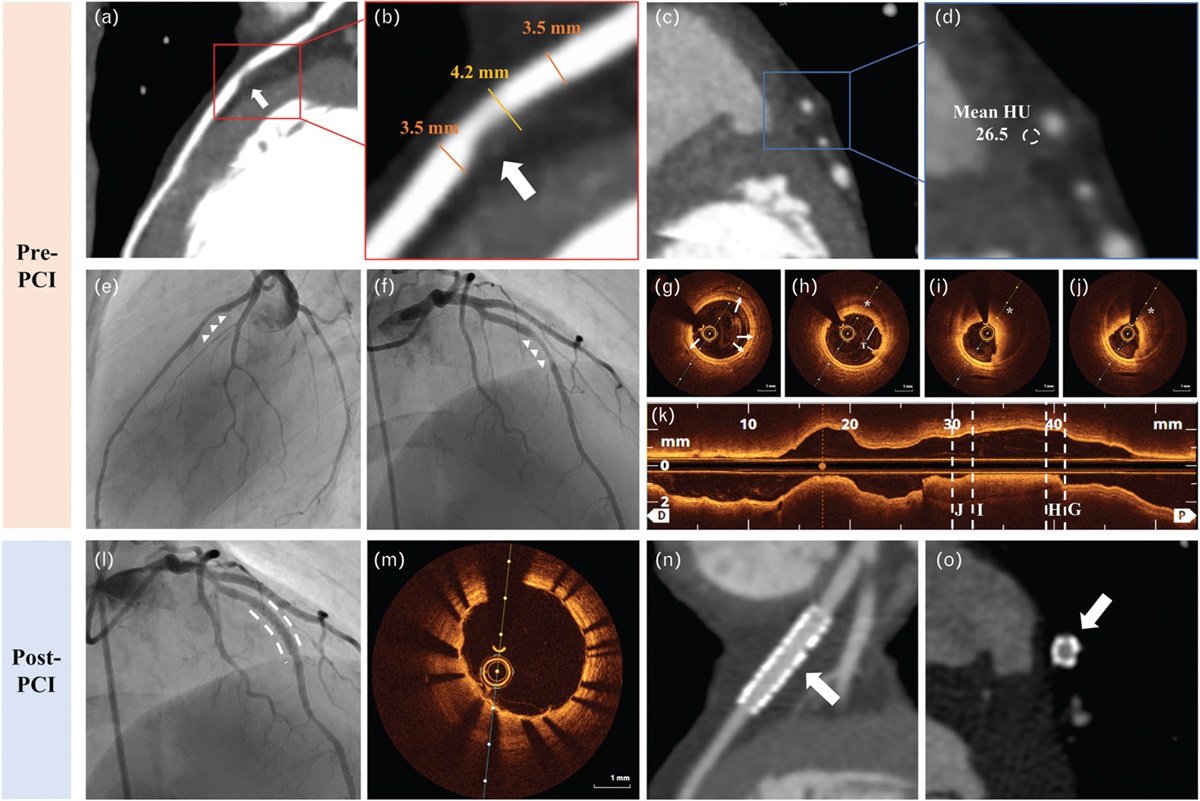 Coronary computed tomography angiography and optical coherence tomography imaging of an intraplaque hemorrhage