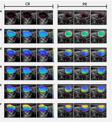 Predicting head and neck cancer treatment outcomes with pre-treatment quantitative ultrasound texture features and optimising machine learning classifiers with texture-of-texture features