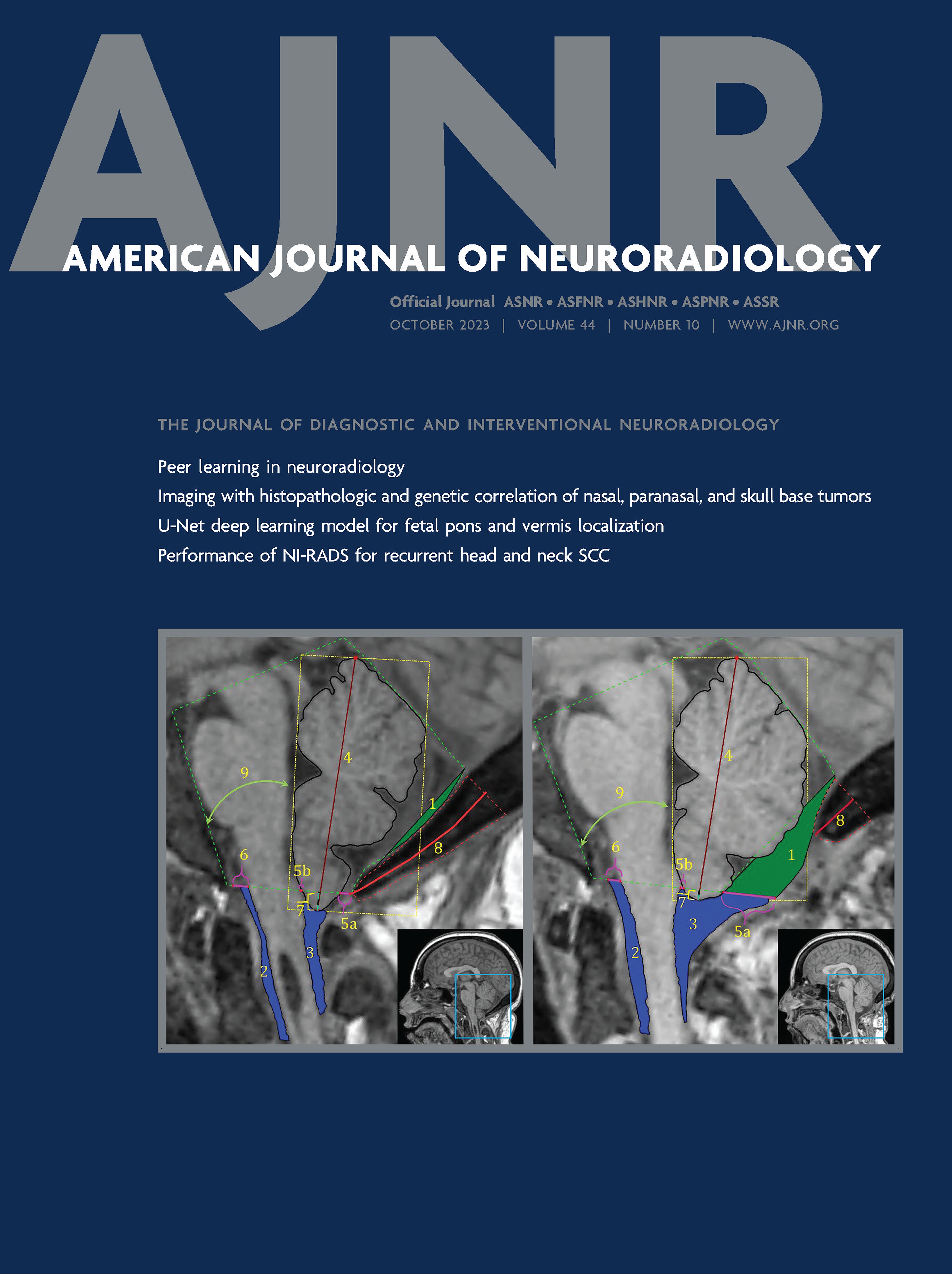 Cortical and Subcortical Brain Atrophy Assessment Using Simple Measures on NCCT Compared with MRI in Acute Stroke [ADULT BRAIN]