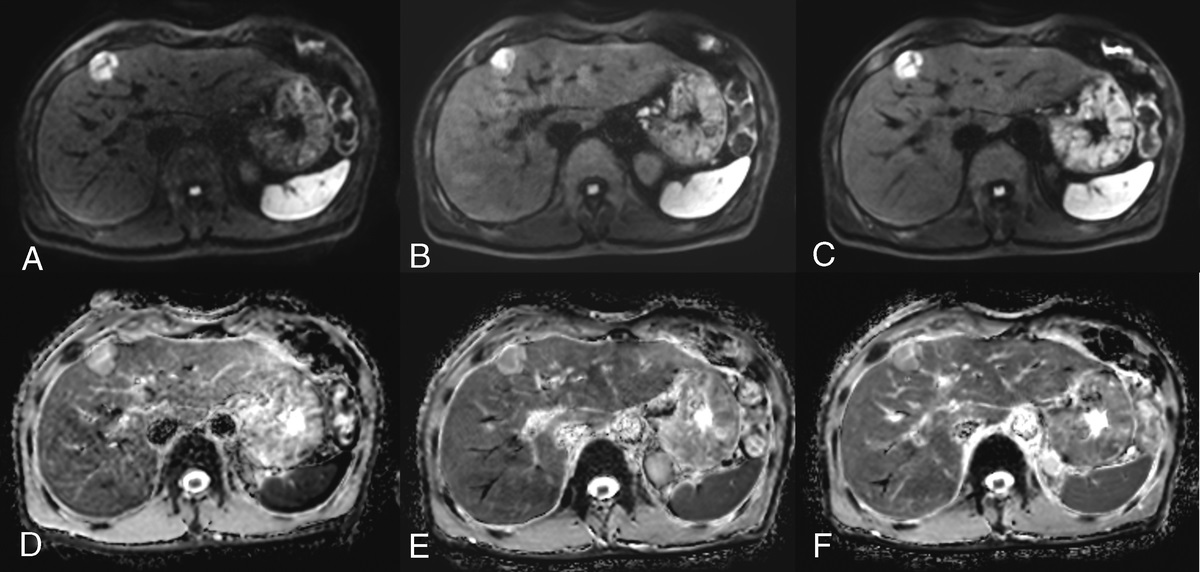 Deep Learning–Accelerated Liver Diffusion-Weighted Imaging: Intraindividual Comparison and Additional Phantom Study of Free-Breathing and Respiratory-Triggering Acquisitions