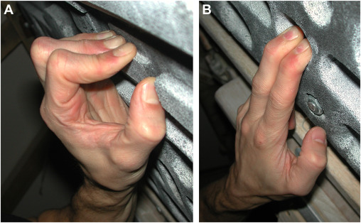 Stress Fractures of the Distal Phalanx in Skeletally Immature Sport Climbers
