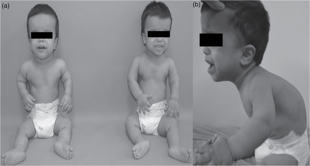 Case of twin achondroplasia and autism coexistence and literature review