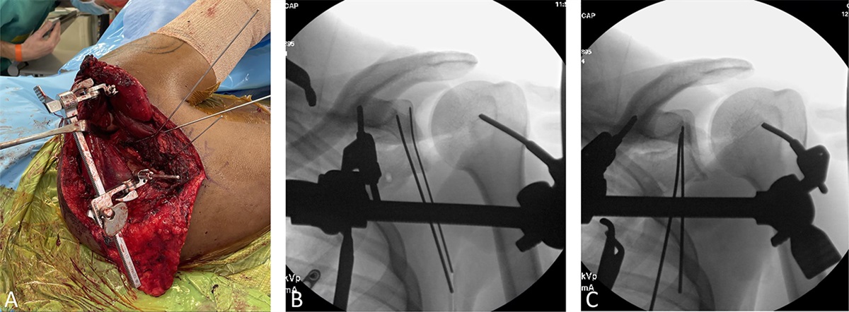 Distractor Application and Dry Arthroscopy to Improve Articular Visualization During Scapula Fracture Surgery Via a Posterior Approach
