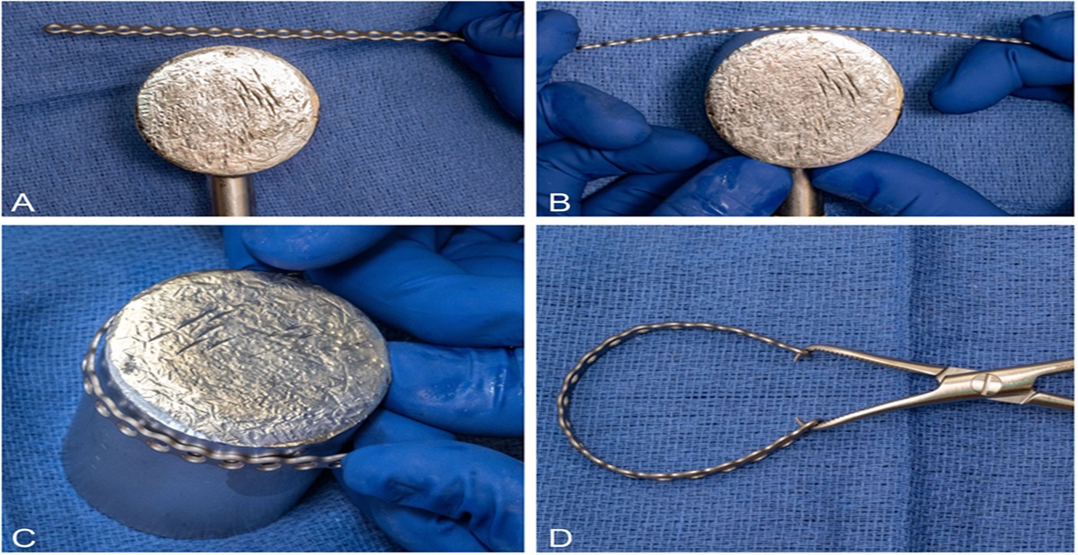 Patella Fracture Fixation With Novel Wagon Wheel Construct Versus Tension-Band Construct: A Technical Trick
