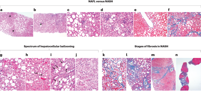 Digital pathology for nonalcoholic steatohepatitis assessment