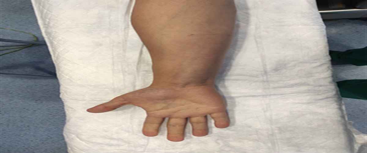 Median nerve compression by a reversed palmaris longus in the distal forearm: a case report