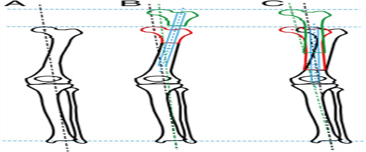 Retrograde Femur Technique for Motorized Internal Limb Lengthening