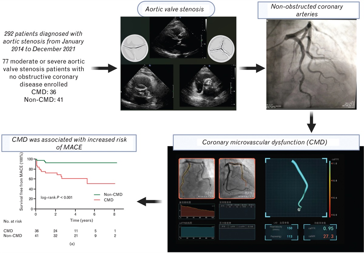 Prognostic value of coronary microvascular dysfunction in patients with aortic stenosis and nonobstructed coronary arteries