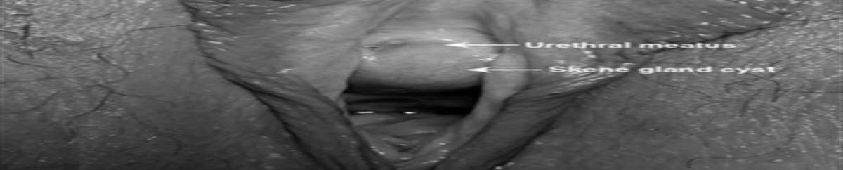 Incidental Finding of a Skene Gland Cyst in the Emergency Department