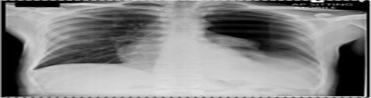 Re-expansion Pulmonary Edema: A Rare Complication of Chest Drain Insertion in Spontaneous Pneumothorax