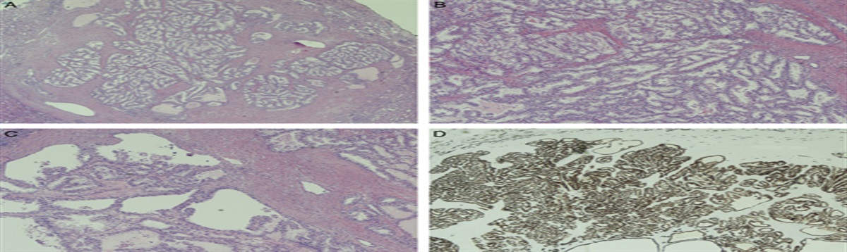 Renal Cell Carcinoma Associated With TSC/MTOR Genomic Alterations: An Update on its Expanding Spectrum and an Approach to Clinicopathologic Work-up