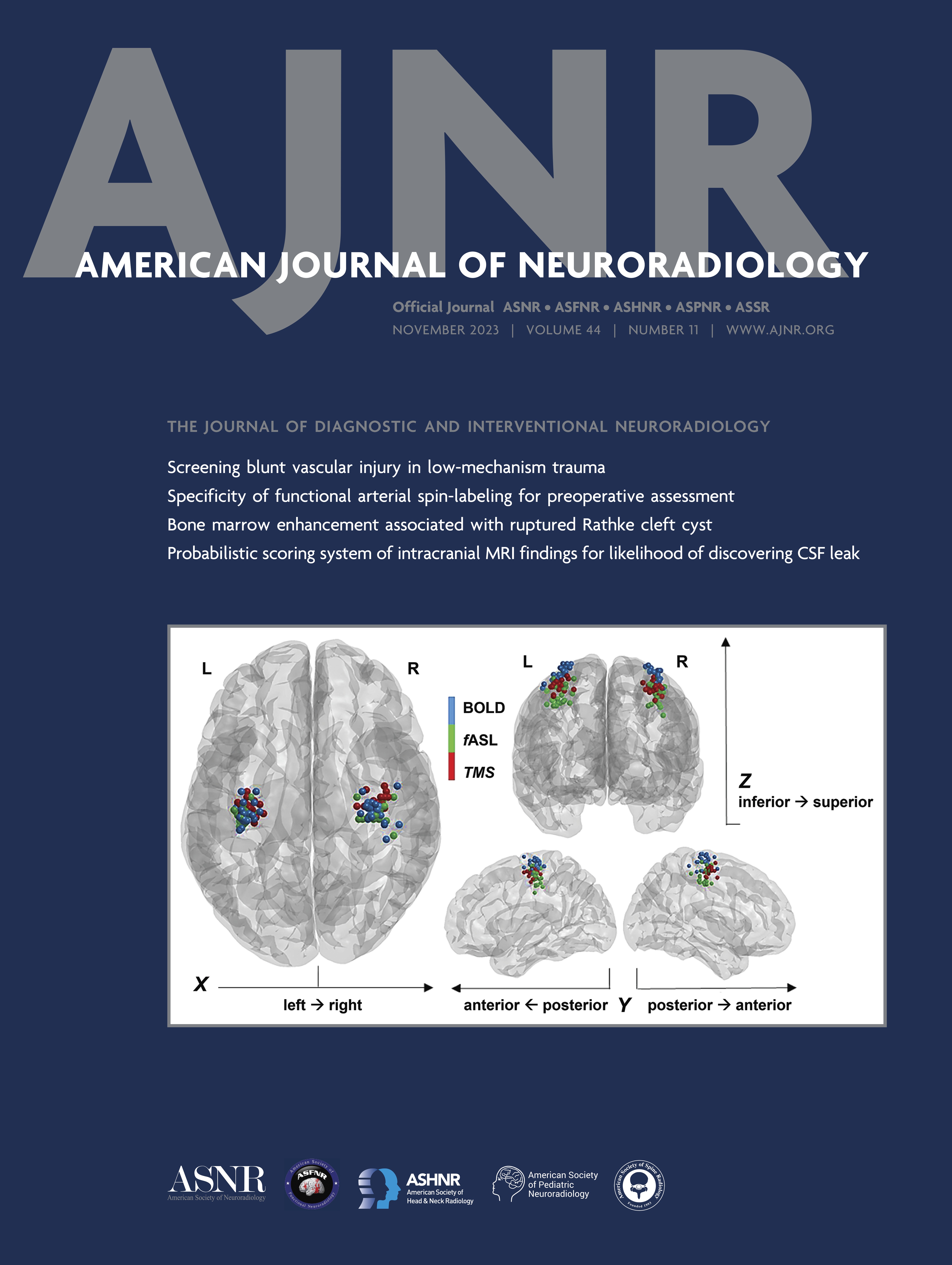 Perfusion Collateral Index versus Hypoperfusion Intensity Ratio in Assessment of Collaterals in Patients with Acute Ischemic Stroke [NEUROVASCULAR/STROKE IMAGING]
