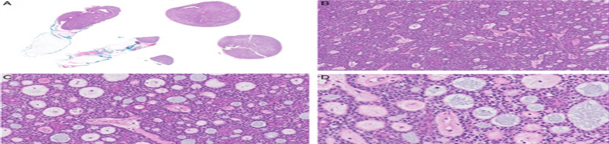Spiradenoma With Adenoid Cystic Carcinoma–like Changes: A Case Series of This Rare Variant With a Potential Diagnostic Pitfall