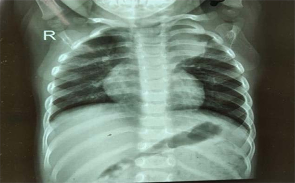 Pulmonary Tuberculosis Mimics in Children: A Case Report