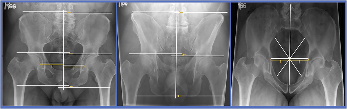 Does Fracture Pattern Really Predict Displacement of LC1 Sacral Fractures?