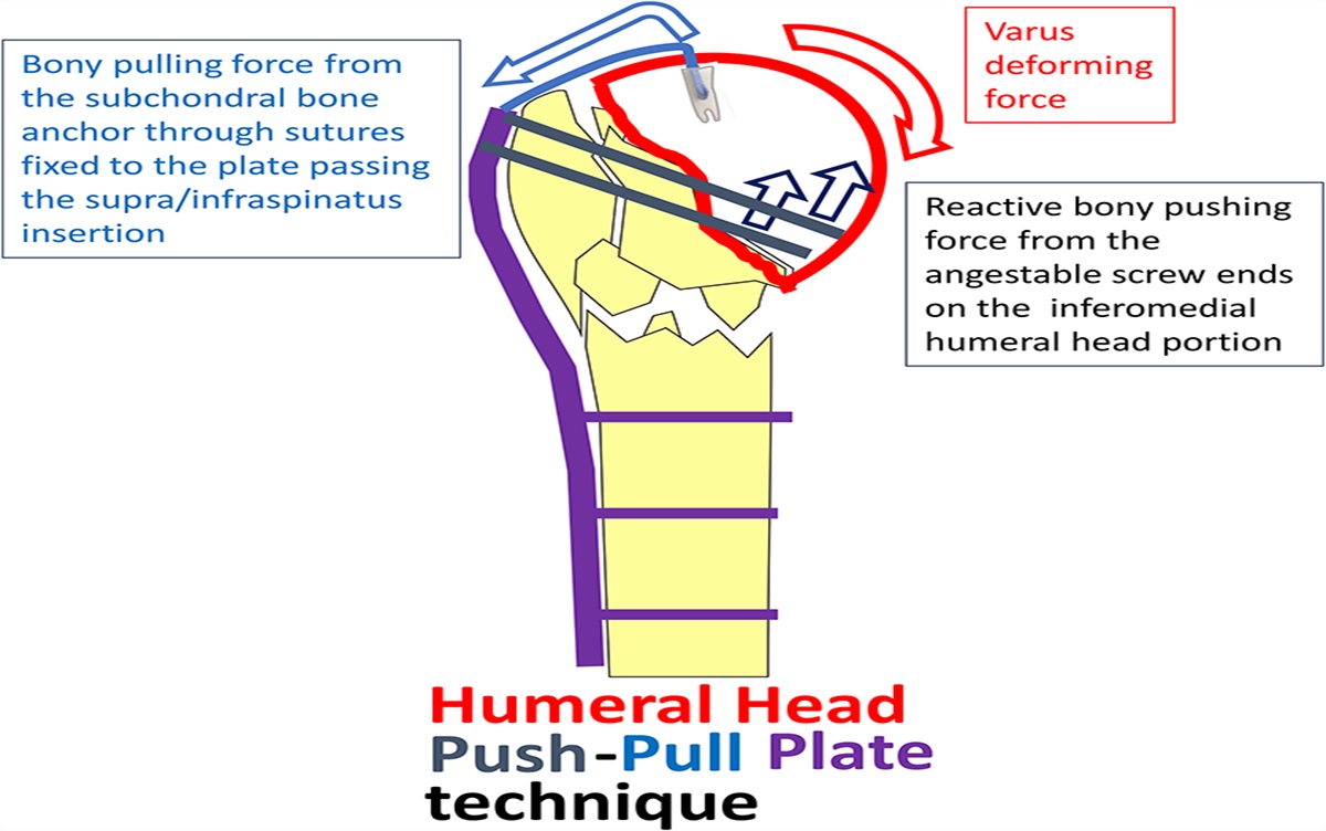 The Humeral Head Push–Pull Plate Technique: An Alternative Way to Stabilize the Humeral Head in Varus Angulated Proximal Humeral Fractures in the Elderly