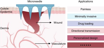 Novel microneedle platforms for the treatment of wounds by drug delivery: A review