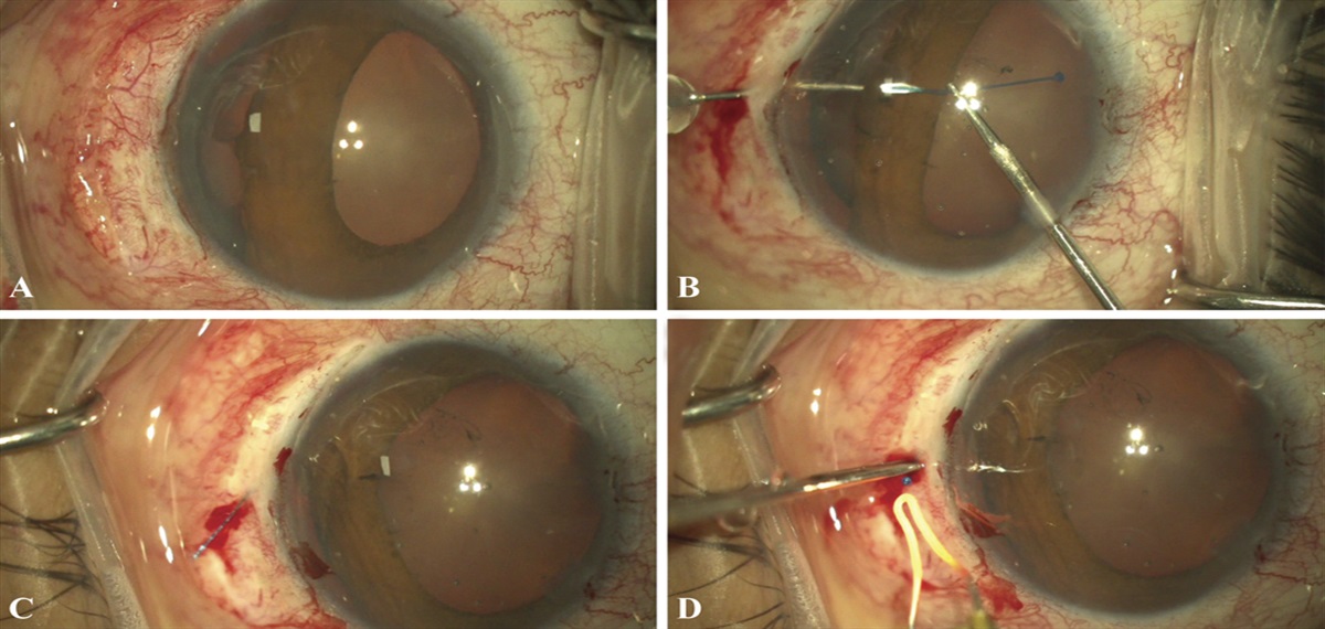 Iridodialysis Repair With Intrascleral Fixation of Flattened Flanged Polypropylene Suture