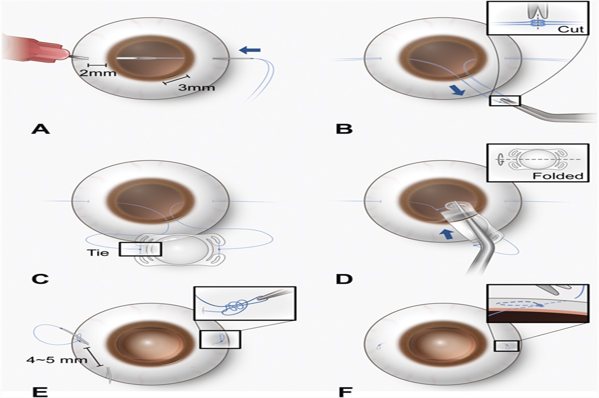 Intraocular Suture Technique for Flapless Two-Point Fixation of Four Fenestrated Haptics Intraocular Lenses
