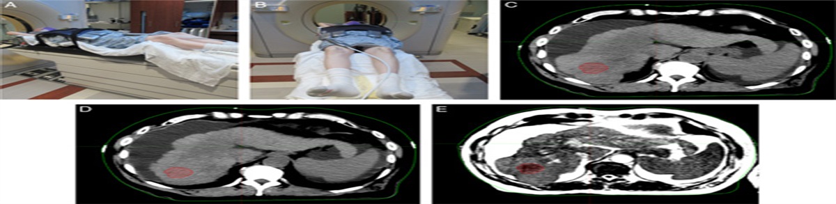 MRI-guided Real-time Online Gated Stereotactic Body Radiation Therapy for Liver Tumors