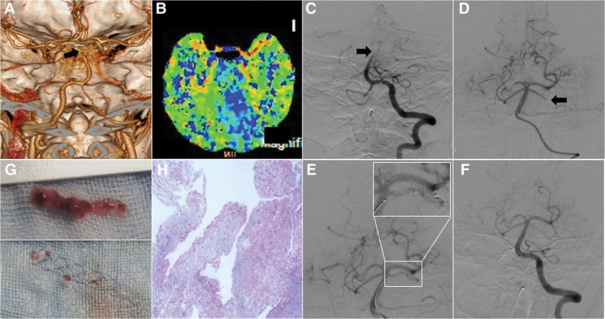 Atrial myxoma embolization of the basilar artery presenting with a convulsive seizure: Case report