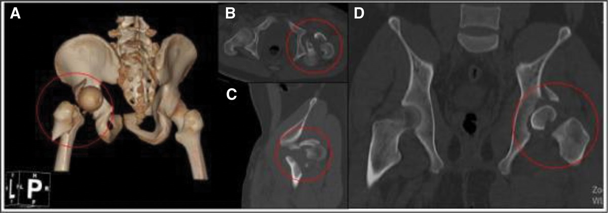 Ipsilateral femoral neck, intertrochanteric and acetabular fractures with posterior dislocation of the hip: A case report and literature review