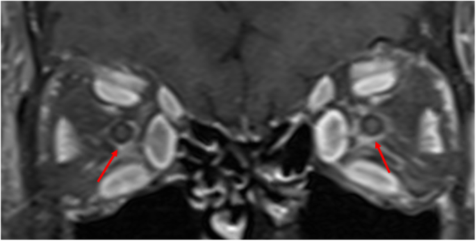 Optic nerve sheath infiltration in dysthyroid optic neuropathy