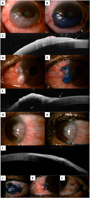 Comparison of non-invasive diagnostic modalities for ocular surface squamous neoplasia at a tertiary hospital, South Africa
