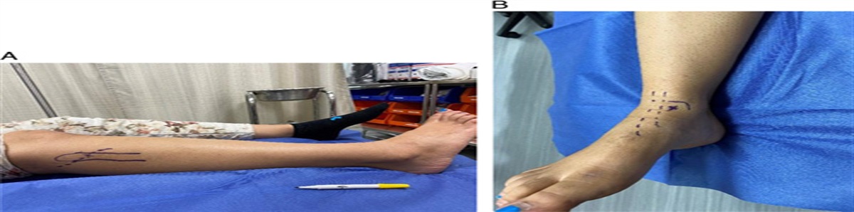 The Single-Person Lateral Decubitus Ankle Sling Fracture Reduction Technique