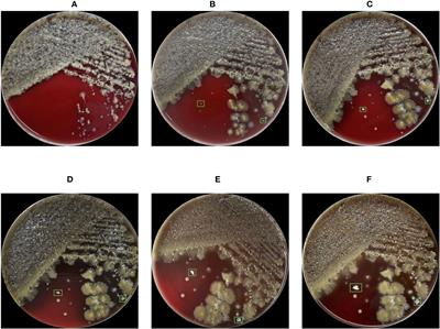 Clinical screening of Nocardia in sputum smears based on neural networks