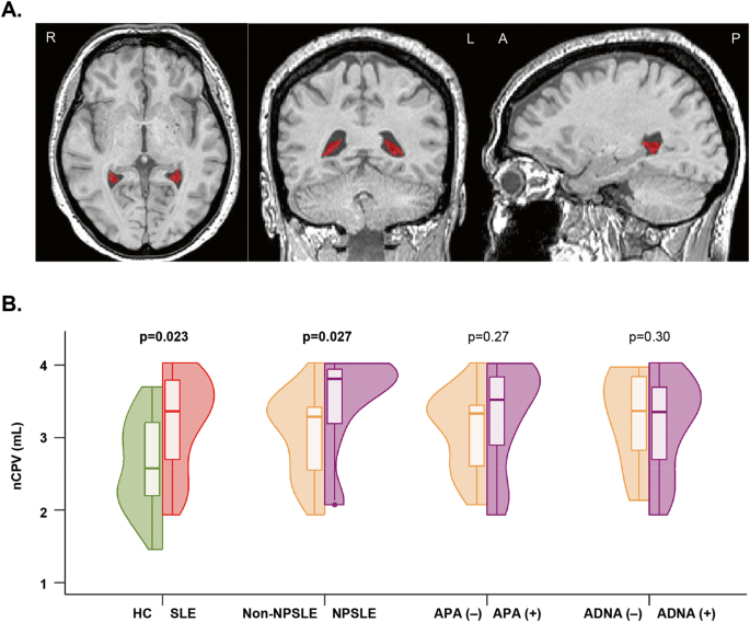 Choroid plexus and perivascular space enlargement in neuropsychiatric systemic lupus erythematosus