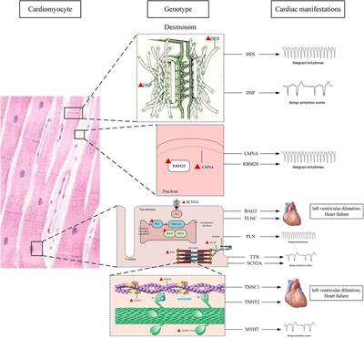 Comprehensive review on gene mutations contributing to dilated cardiomyopathy