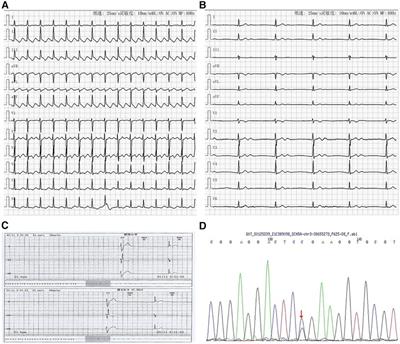 Case Report: SCN5A mutations in three young patients with sick sinus syndrome