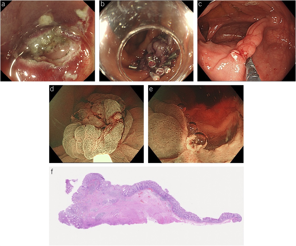 Underwater Endoscopic Full-Thickness Resection With Snare as a Salvage Technique for Residual Colon Lesion