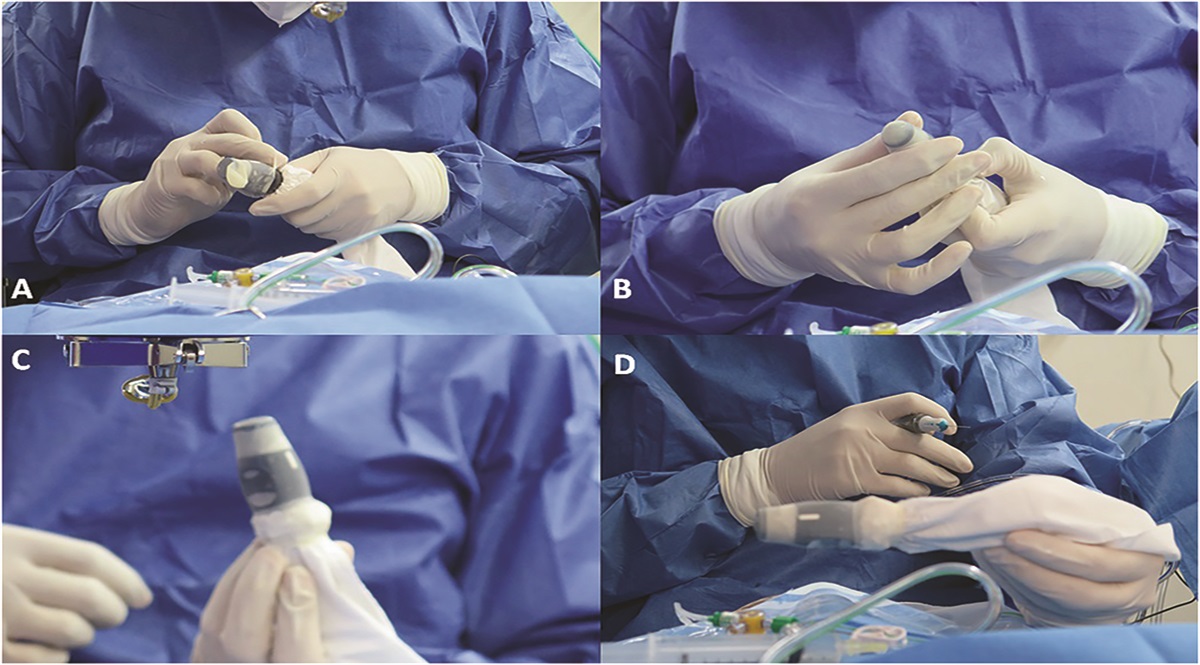 Ultrasound-Guided Pars Plana Vitrectomy