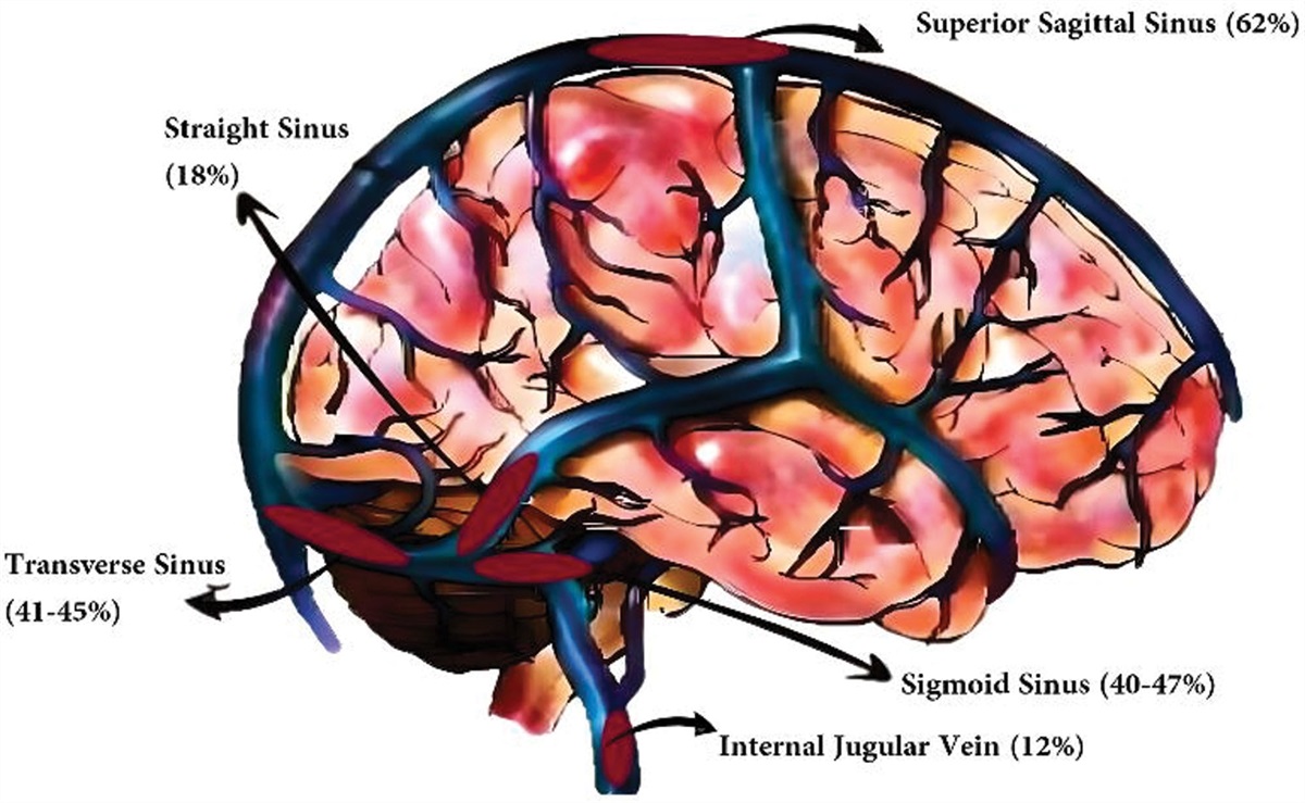 Pathophysiology, diagnosis and management of cerebral venous thrombosis: A comprehensive review