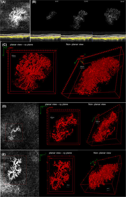 Volume-rendering three-dimensional image analysis of macular neovascularization in age-related macular degeneration