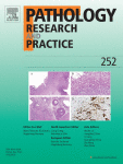 Role of O-GlcNAcylation in cancer biology